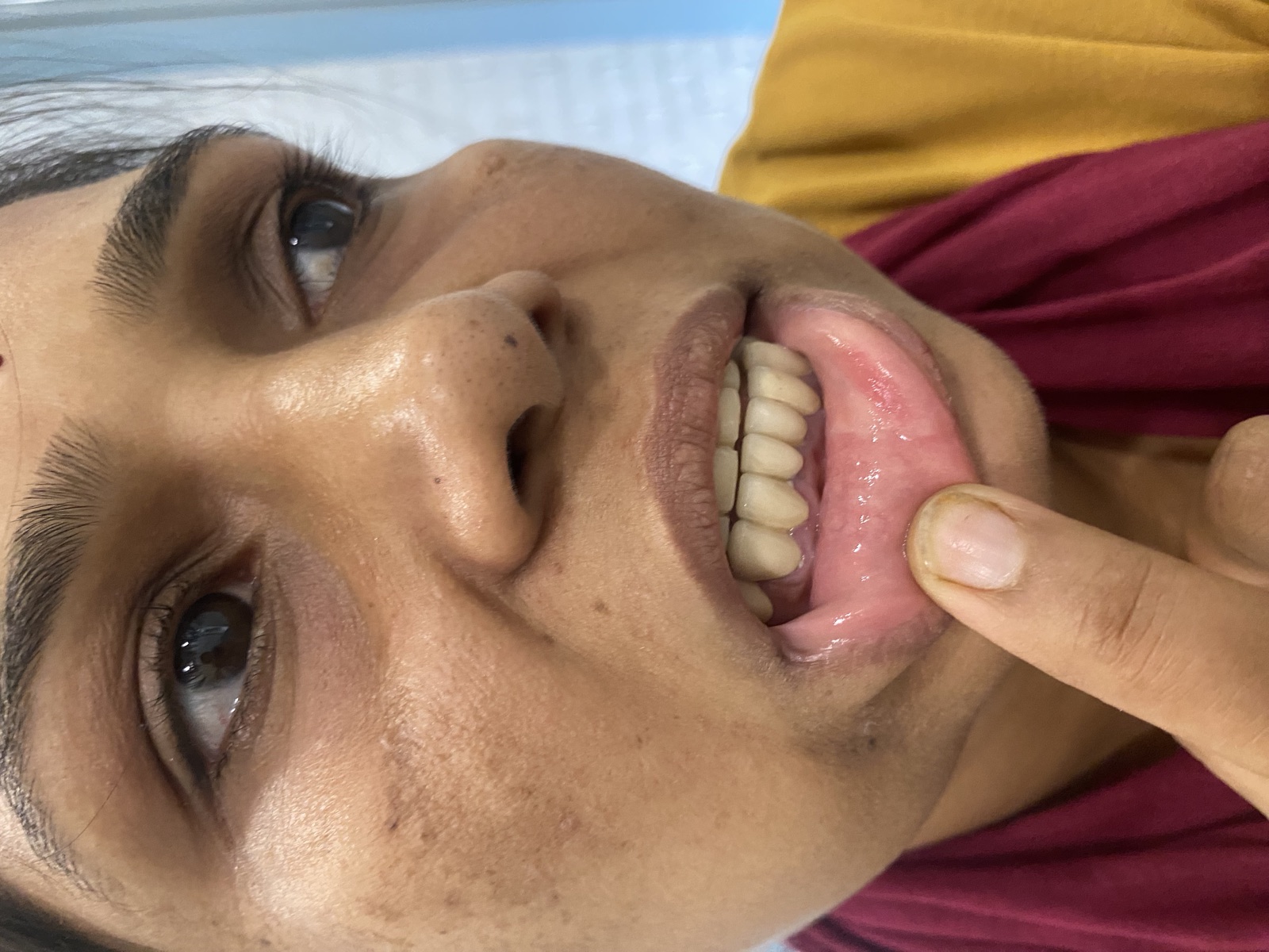 After — Upper anterior rehabilitation with ceramic crowns at Shreeji Dental