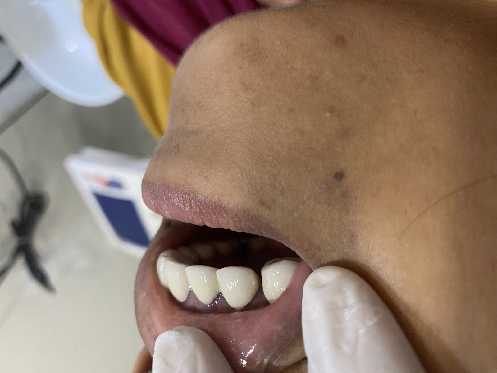 Before — Upper anterior rehabilitation with ceramic crowns at Shreeji Dental