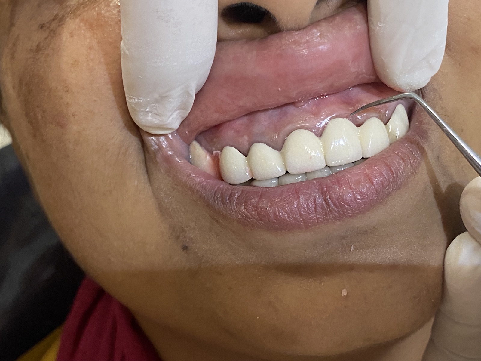 Mid-treatment: shade matching and crown preparation under loupes — colour selected against adjacent natural dentition for a seamless blend.