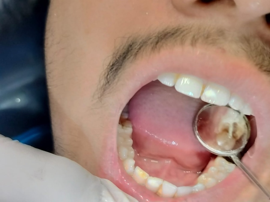 Before — Professional cleaning & stain removal at Shreeji Dental